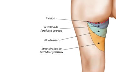 lifting cuisses tunisie : incisions pratiquées 