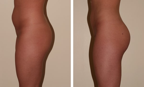 Augmentation fesses Tunisie : photo avant/après