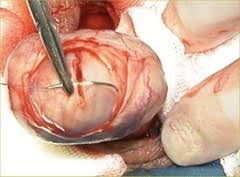 biopsie-testiculaire-tunisie
