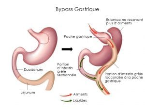 Bypass-gastrique-tunisie